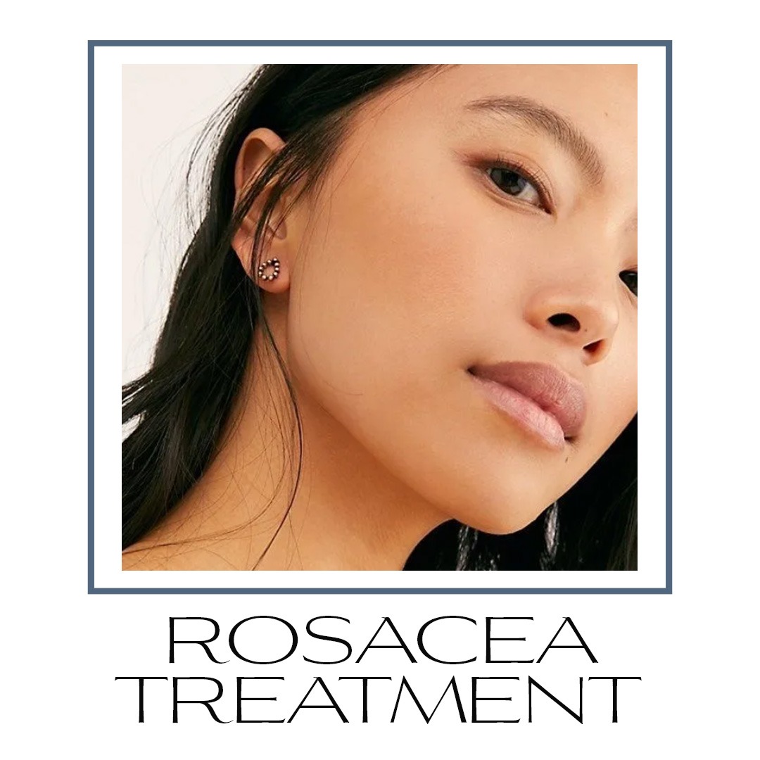 rosacea treatment