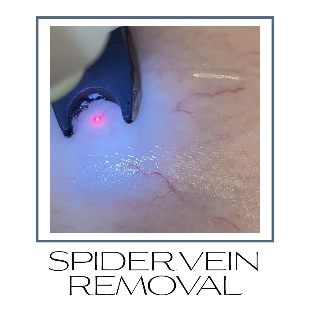 spider vein removal